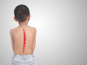 kid with scoliosis